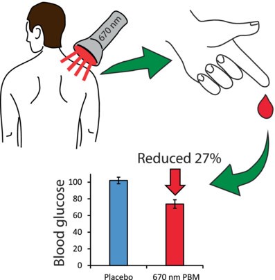 Non-Invasive Photobiomodulation Therapies for Diabetes Management and Complication Reduction 3